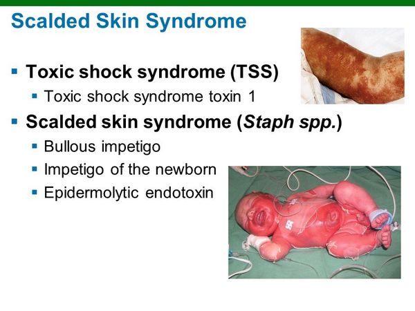 Impetigo and staphylococcal scalded skin syndrome