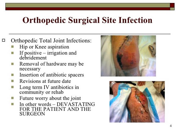 Orthopedic Infections
