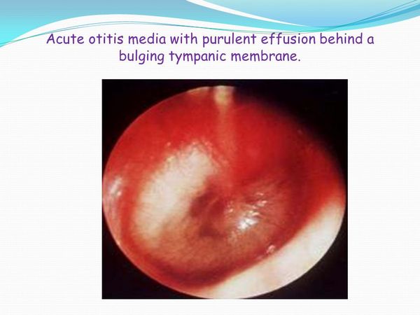 ALLOIOCOCCUS OTITIS