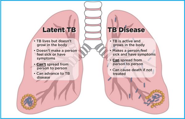 Latent Tuberculosis Infection