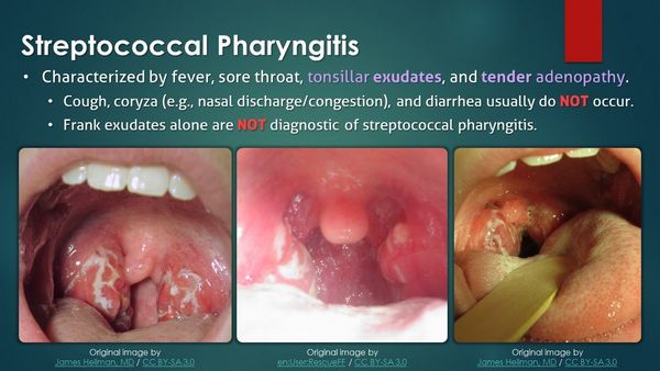 PHARYNGITIS