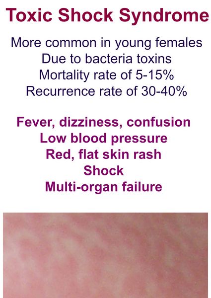 Toxic Shock Syndrome Toxic Shock Syndrome
