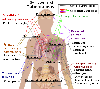 Tuberculosis