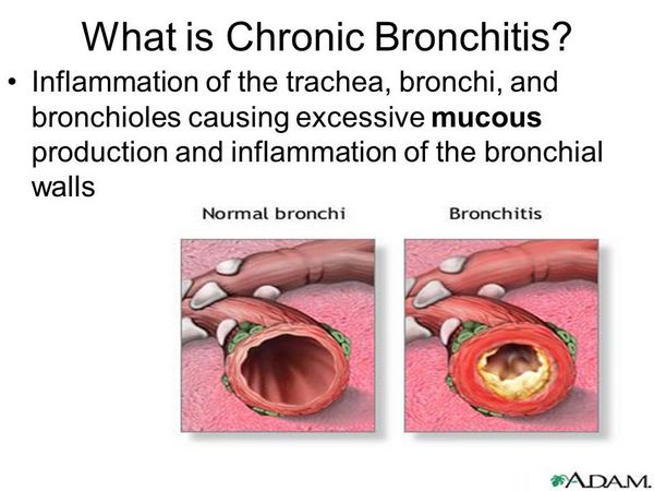 What is Chronic Bronchitis? What is Chronic Bronchitis?