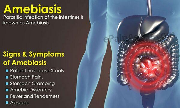 Amebiasis