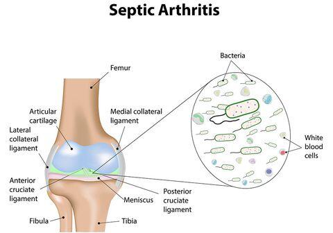Arthritis, infectious