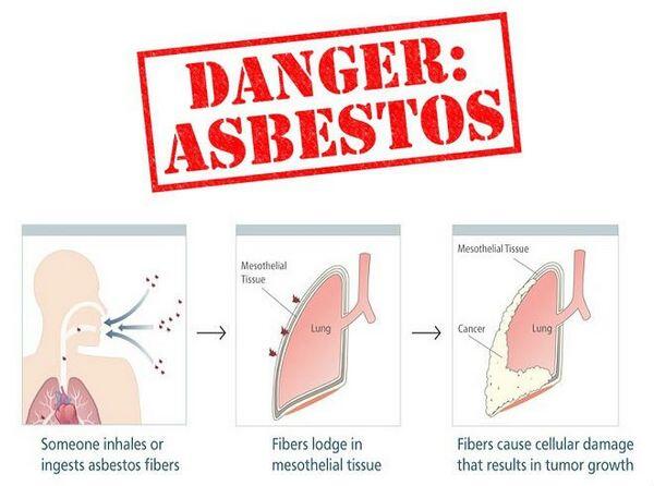 Asbestosis