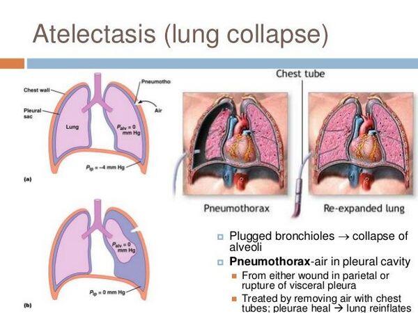 Atelectasis