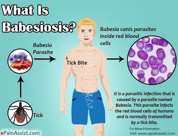 Babesiosis