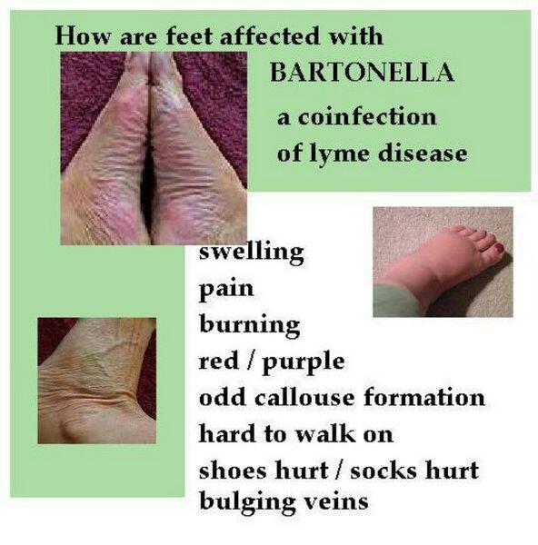 Bartonella Infections