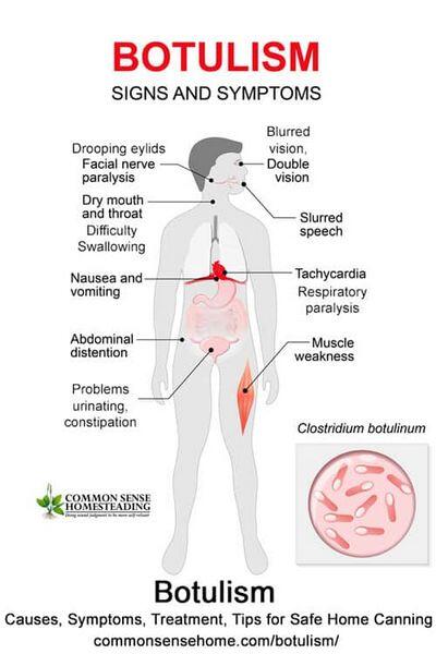 Botulism