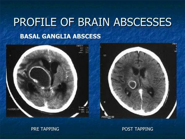 Brain Abscess