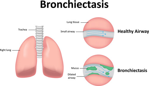 Bronchiectasis