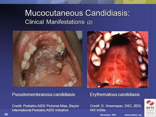 Candidiasis Mucocutaneous
