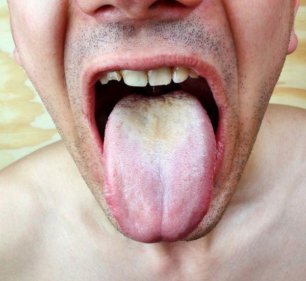 Candidiasis Candidiasis