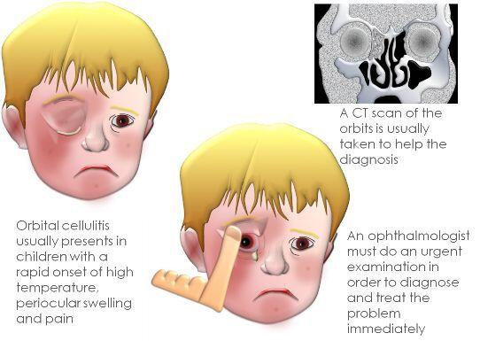 Cellulitis Periorbital & Orbital