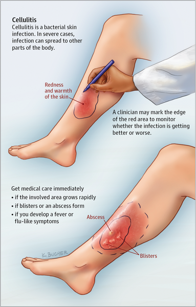 Cellulitis