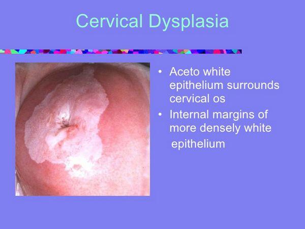 Cervical Dysplasia