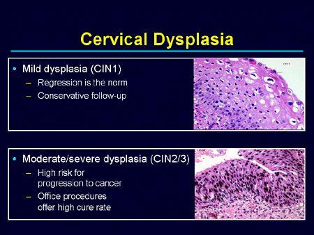 Cervical Dysplasia