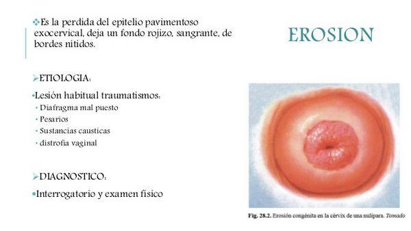 Cervicitis, Ectropion & True Erosion