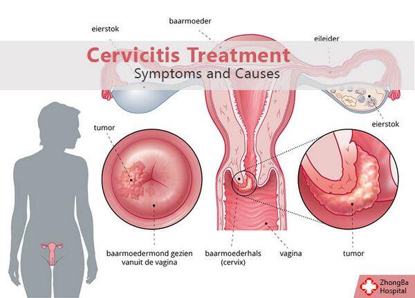 Cervicitis