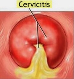 Cervicitis