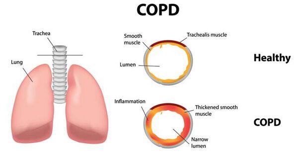 Chronic Obstructive Pulmonary Disease & Emphysema