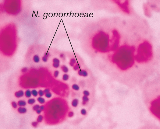 Neisseria gonorrhoeae Neisseria gonorrhoeae