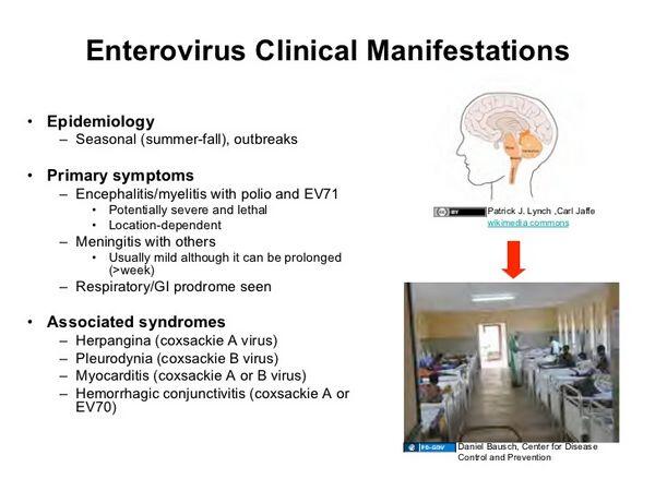 Enteroviruses: Clinical Syndromes