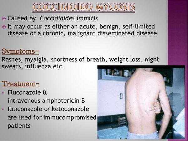 Coccidioidomycosis