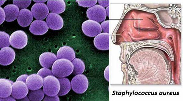 Staphylc-COCCUS Aureus
