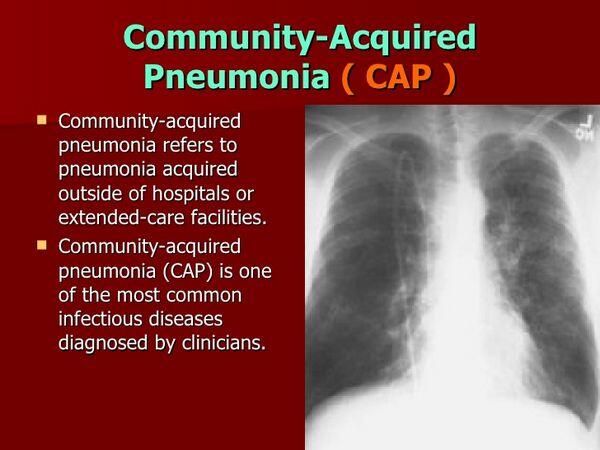 Community-Acquired Pneumonia: Pathophysiology Community-Acquired Pneumonia: Pathophysiology