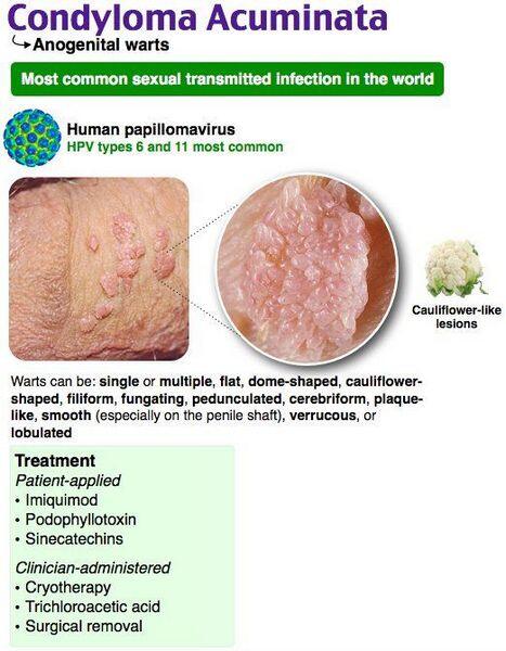 condyloma acuminatum etiológiája
