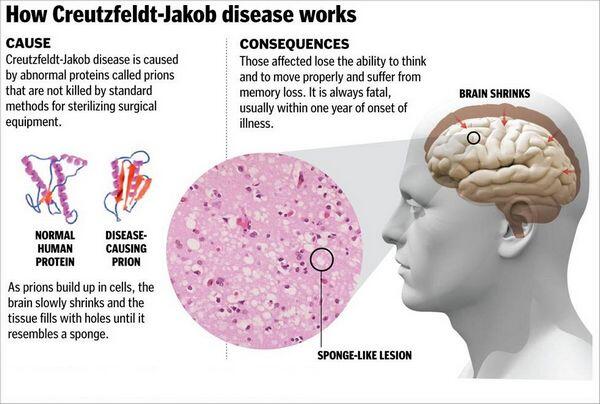 Creutzfeldt-Jakob Disease