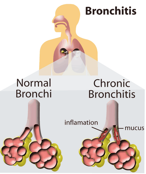 Acute Exacerbations of Chronic Bronchiti Acute Exacerbations of Chronic Bronchiti