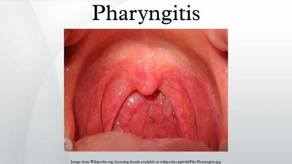 Pharyngitis and Tonsillitis