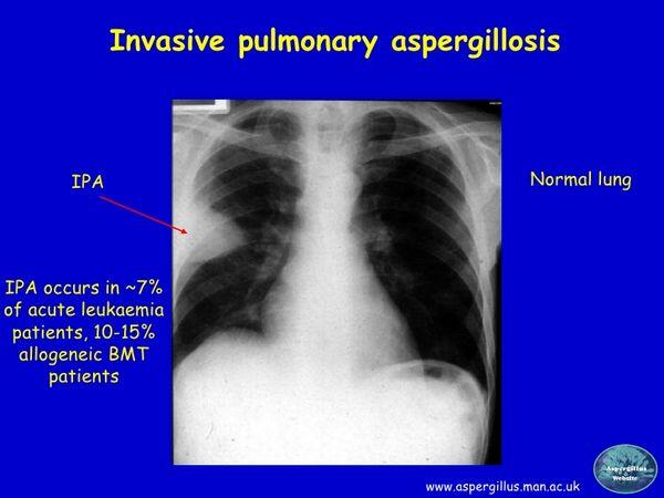 Invasive Aspergillosis