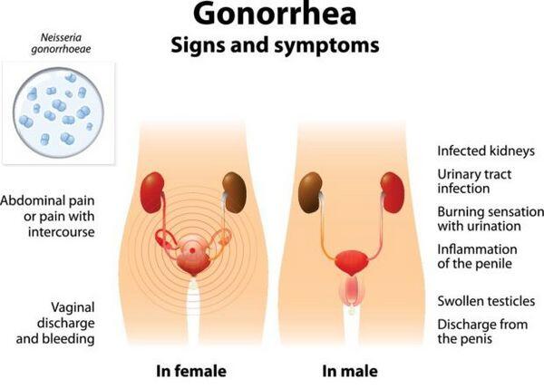 Gonorrhea Gonorrhea