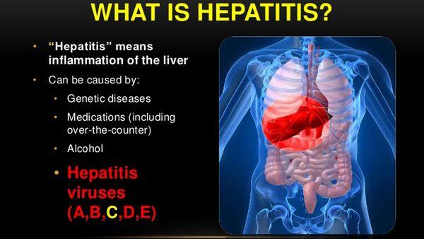 Hepatitis