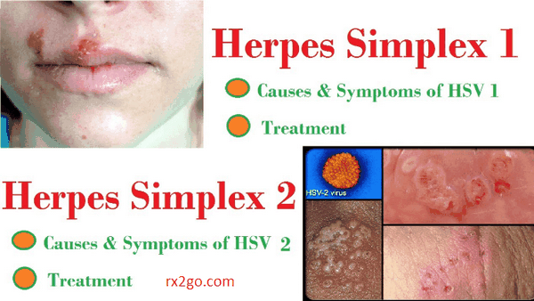 Herpes Simplex Virus Herpes Simplex Virus