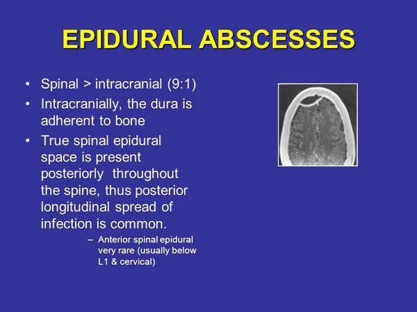 Intracranial Epidural And Subdural Abscess Intracranial Epidural And Subdural Abscess