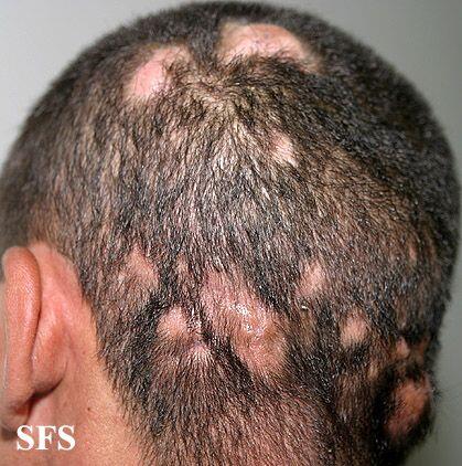 Tinea Capitis Tinea Capitis