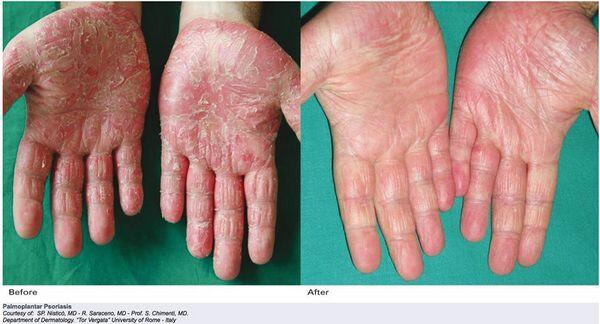 Tinea Manuum