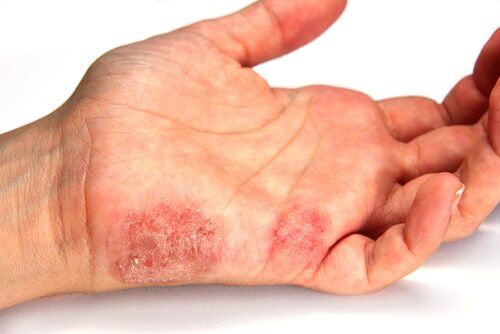 Tinea Manuum Tinea Manuum