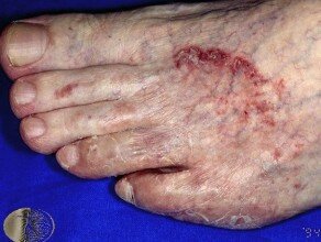 Tinea Pedis Tinea Pedis