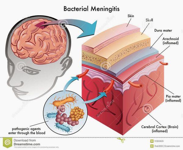 Bacterial Meningitis