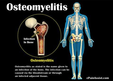 Osteomyelitis Osteomyelitis