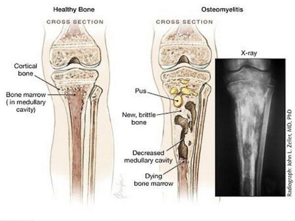 Osteomyelitis Osteomyelitis