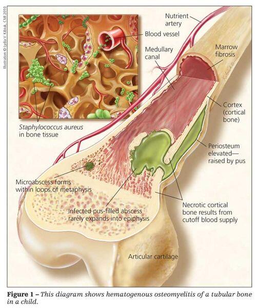 Osteomyelitis Osteomyelitis