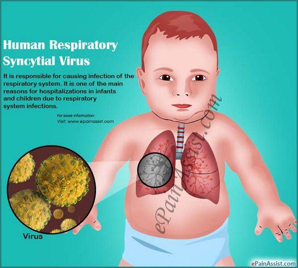 Managing Respiratory Syncytial Virus Infection
